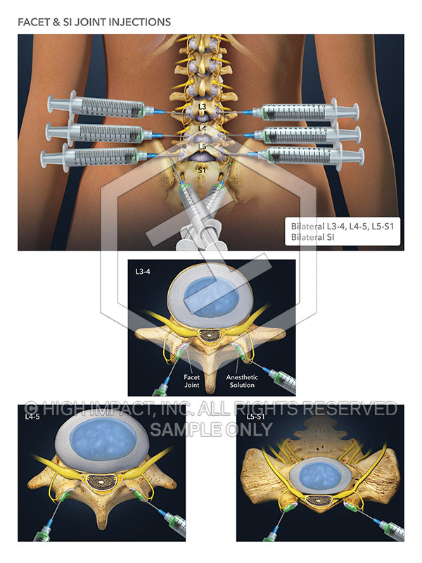 sacroiliac joint injection technique