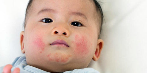 teething rash