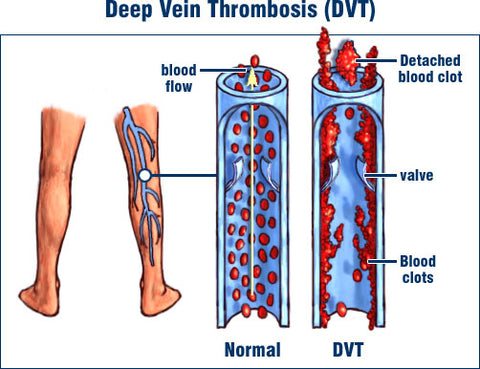 dvt digaram