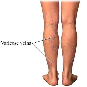 What is Venous Insufficiency? - LegSmart Compression Socks