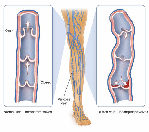 more varicose veins