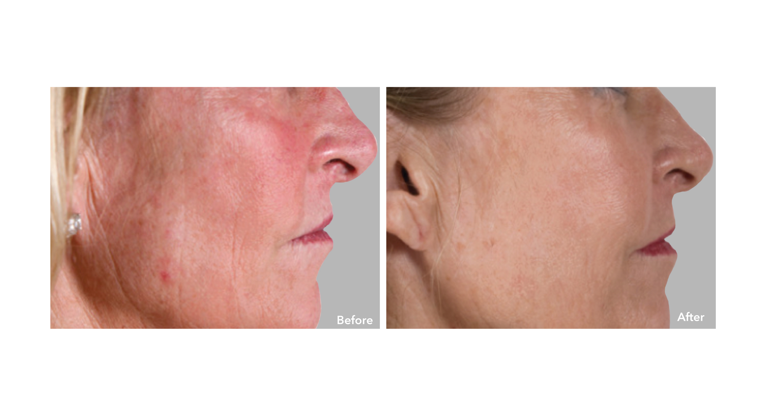 AnteAGE MD System Before and After 1
