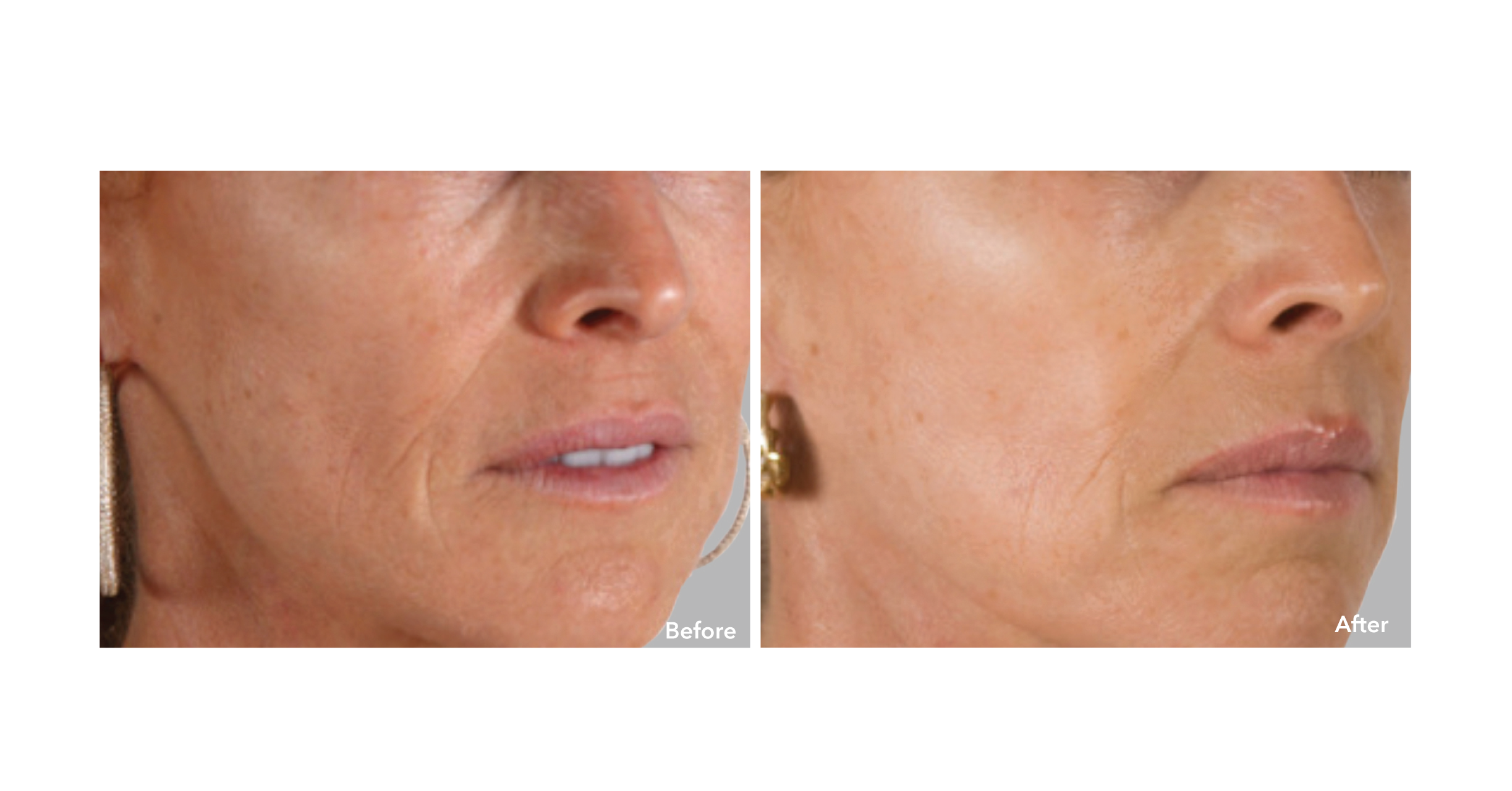 AnteAGE MD System Before and After 2