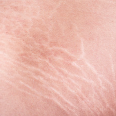 Red Light Therapy to Better Skin Conditions