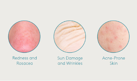 acne, rosacea, mineral sunscreen, zinc oxide, titanium dioxide, sun damage, spf