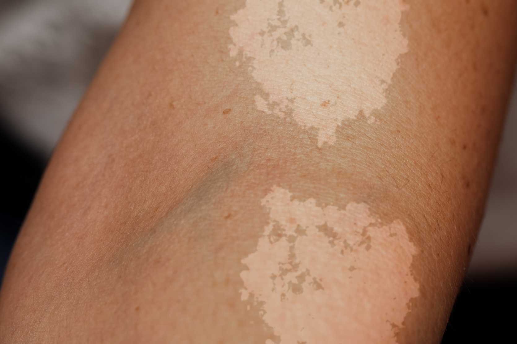 discoloration of the skin