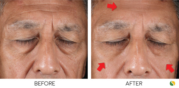 before and after pictures of instant eye bag treatment