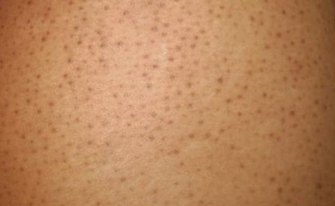 dark pores on legs