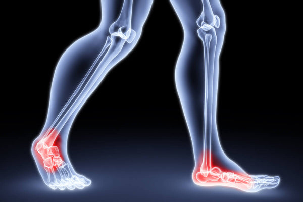 Image showing plantar fasciitis heel pain locations on the foot