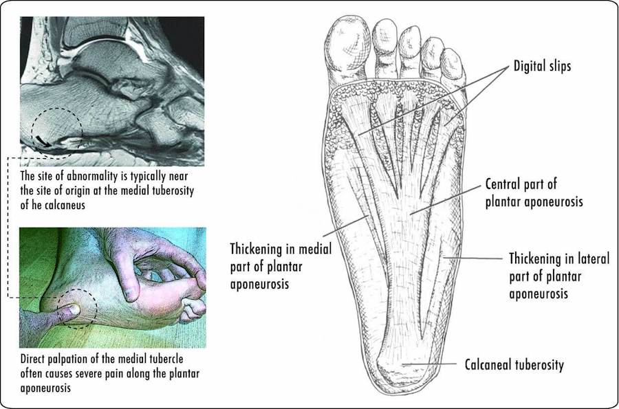 Image showing the Anatomy Of The Foot's Fascia
