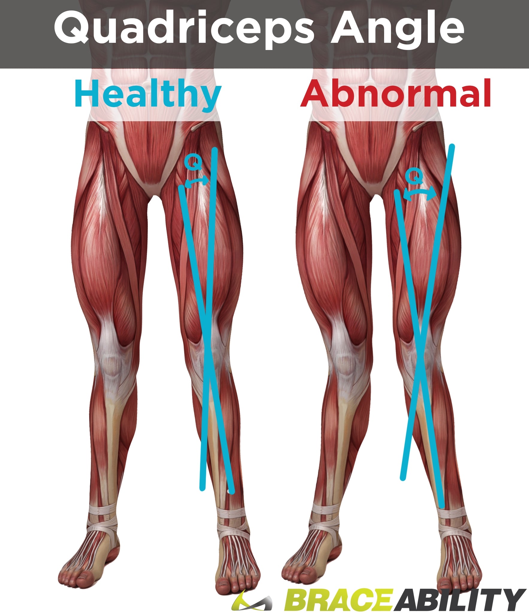 abnormal leg alignment is a possible cause of osgood schlatter knee disease