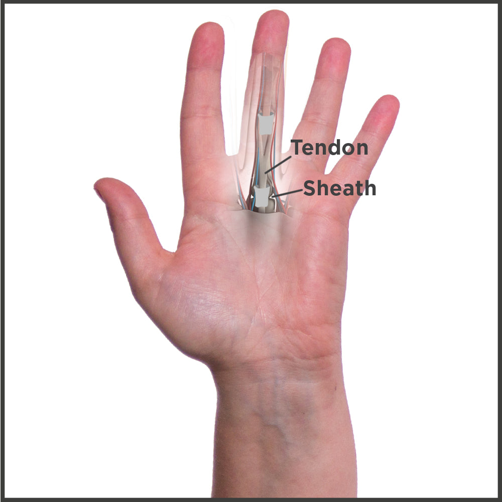 Where the tendon runs through the sheath and gets pinched causing trigger finger
