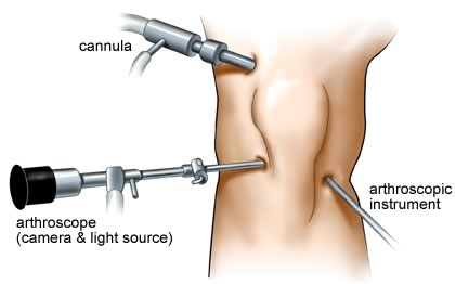graphic showing what arthroscopic surgery for pcl tears looks like