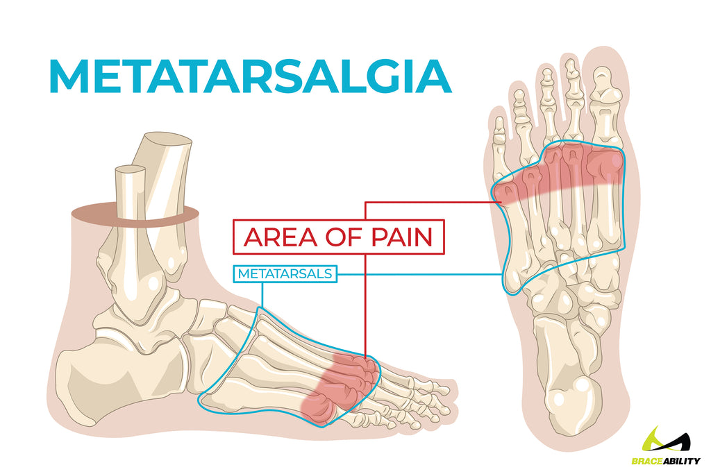 learn about Metatarsalgia and how it causes ball of foot pain