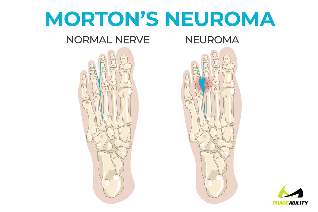 learn about Morton's Neuroma and how it causes ball of foot pain