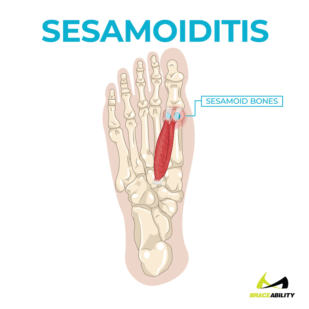 learn about Sesamoiditis and how it causes ball of foot pain