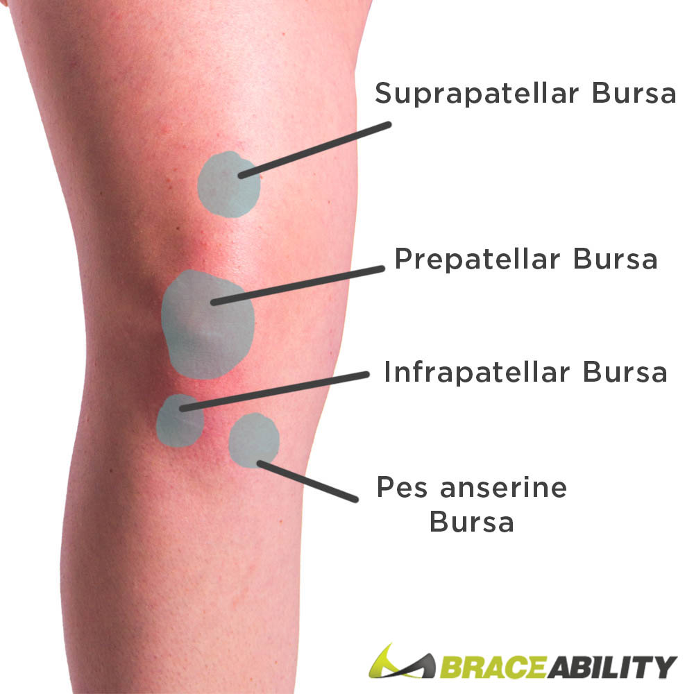 locations of knee pain from bursitis this treatment brace can help