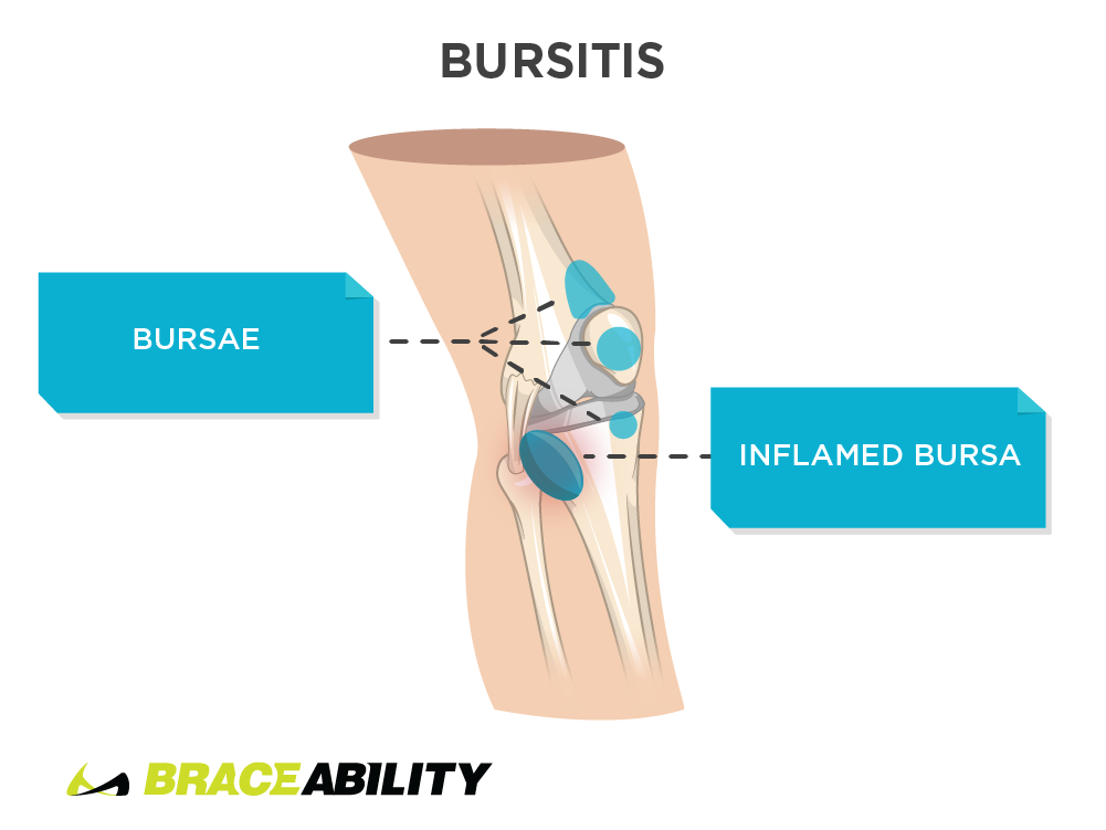 Pain inside the knee from bursitis