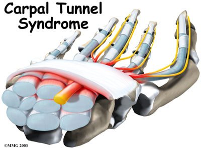 carpal tunnel syndrome is a common hand and thumb injury 