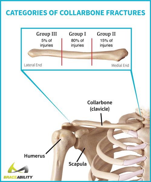 Where collarbone fractures happen and the different categories