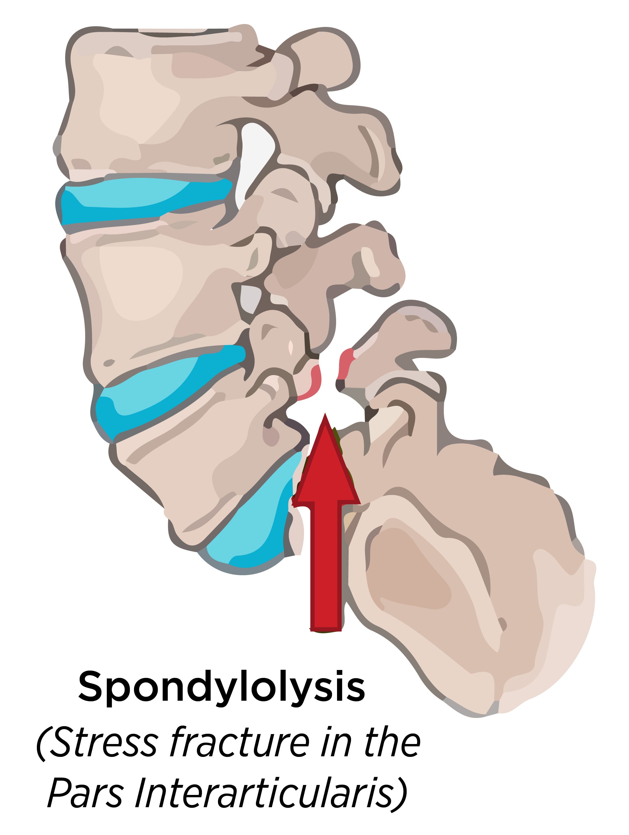 use this chart to understand what spondylolysis looks like in your spine