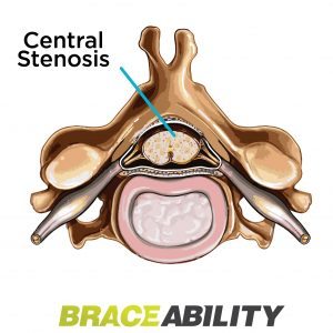 a pinched nerve in the main spinal canal is called central stenosis