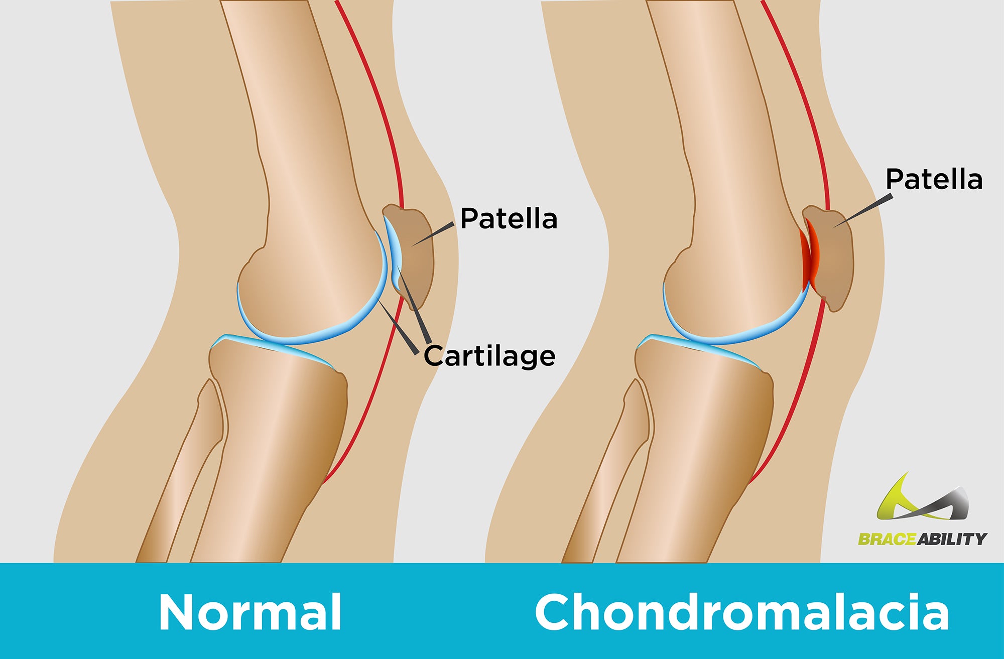 graphic shows how cartilage breaks down with use and causes kneecap to grind when chondromalacia is present