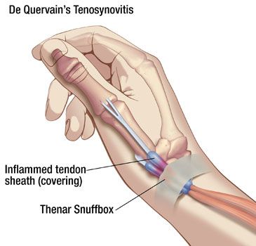 de quervain's thumb syndrome symptoms include inflmmation of tendons at base of thumb