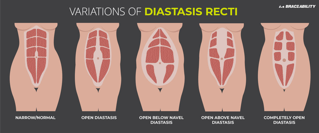 infographic showing how to tell if you have diastasis recti