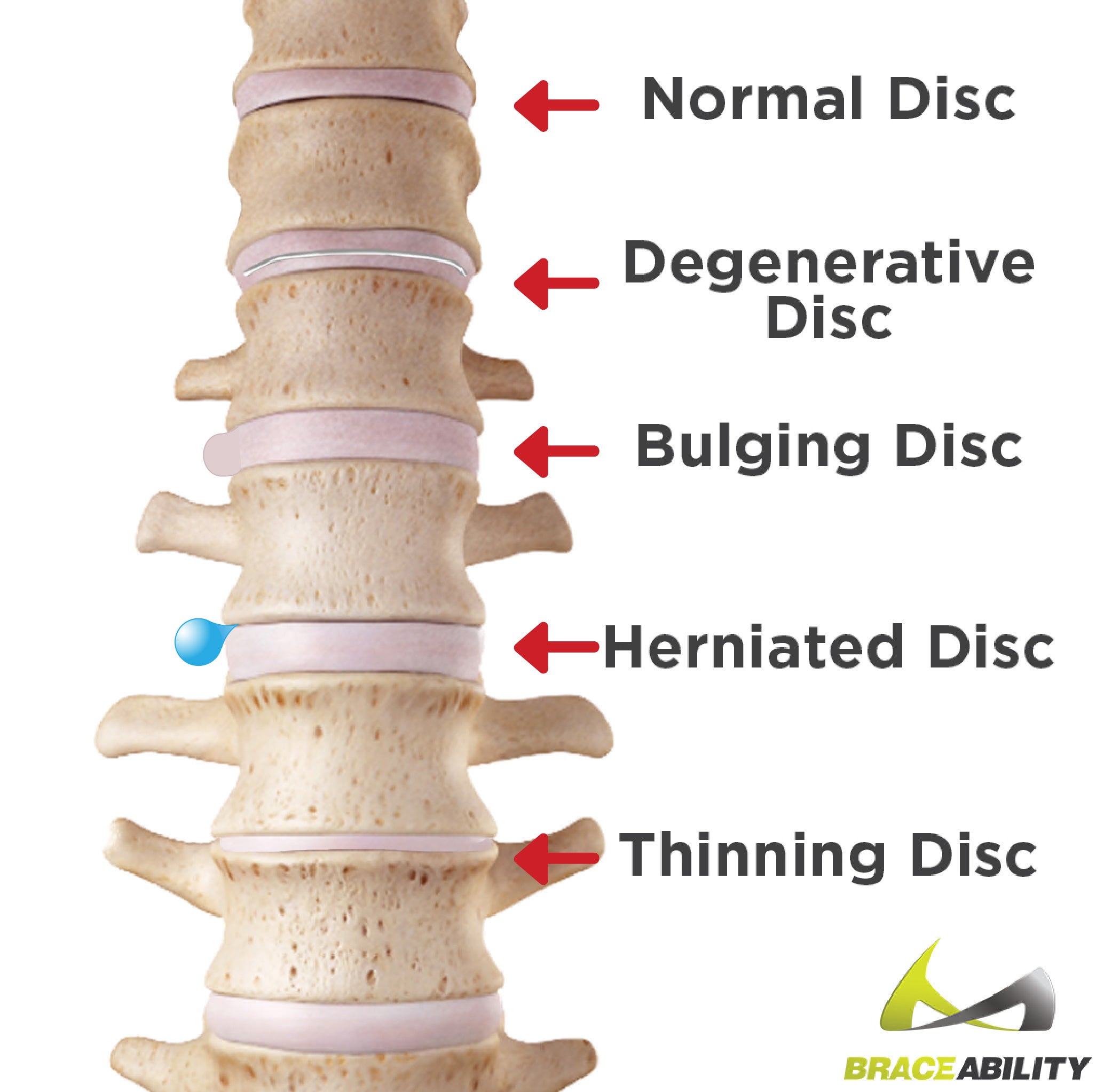 Difference between a bulged disc and a herniated disc in your back