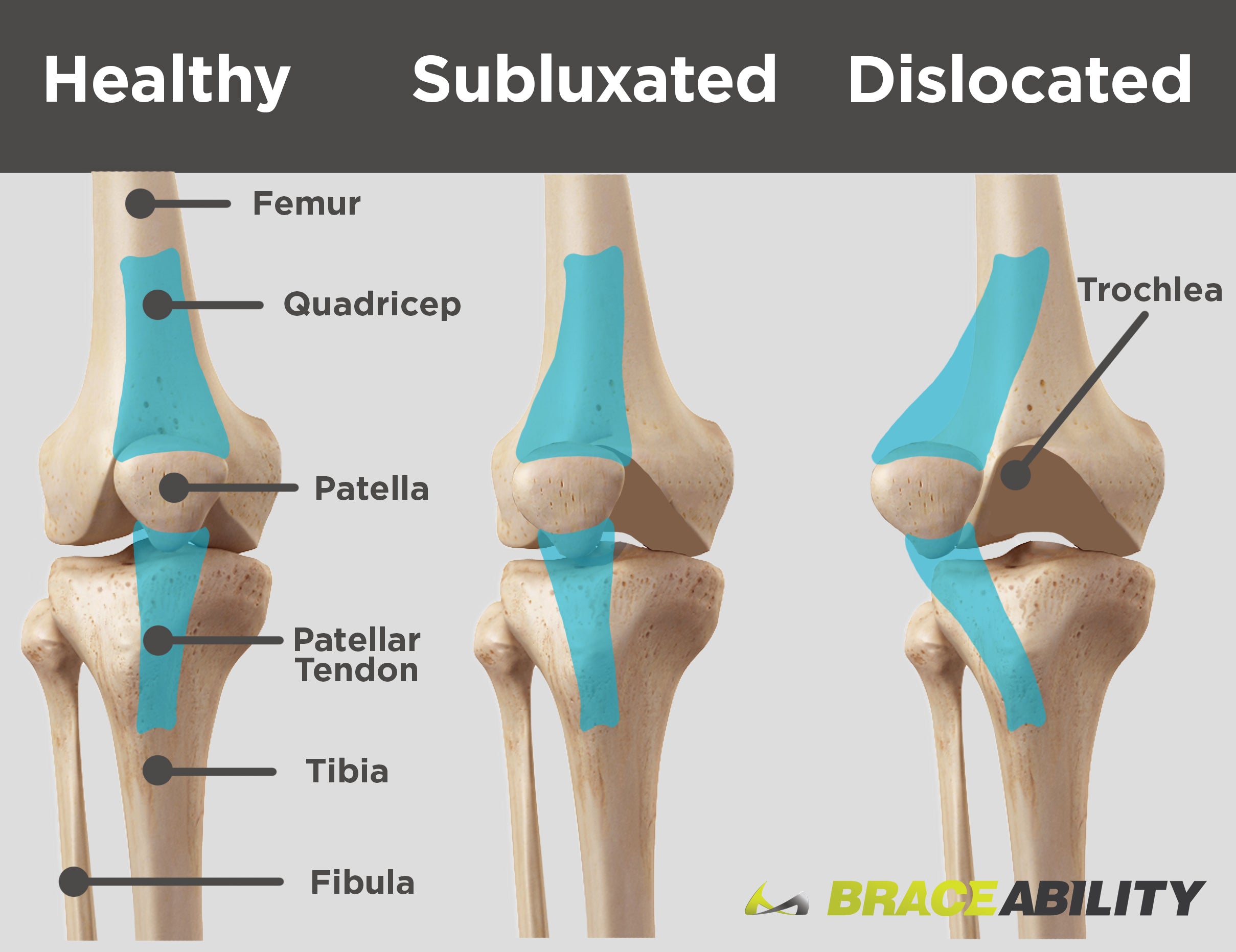 Use this diagram to see the difference between a subluxated kneecap and one that is fully dislocated