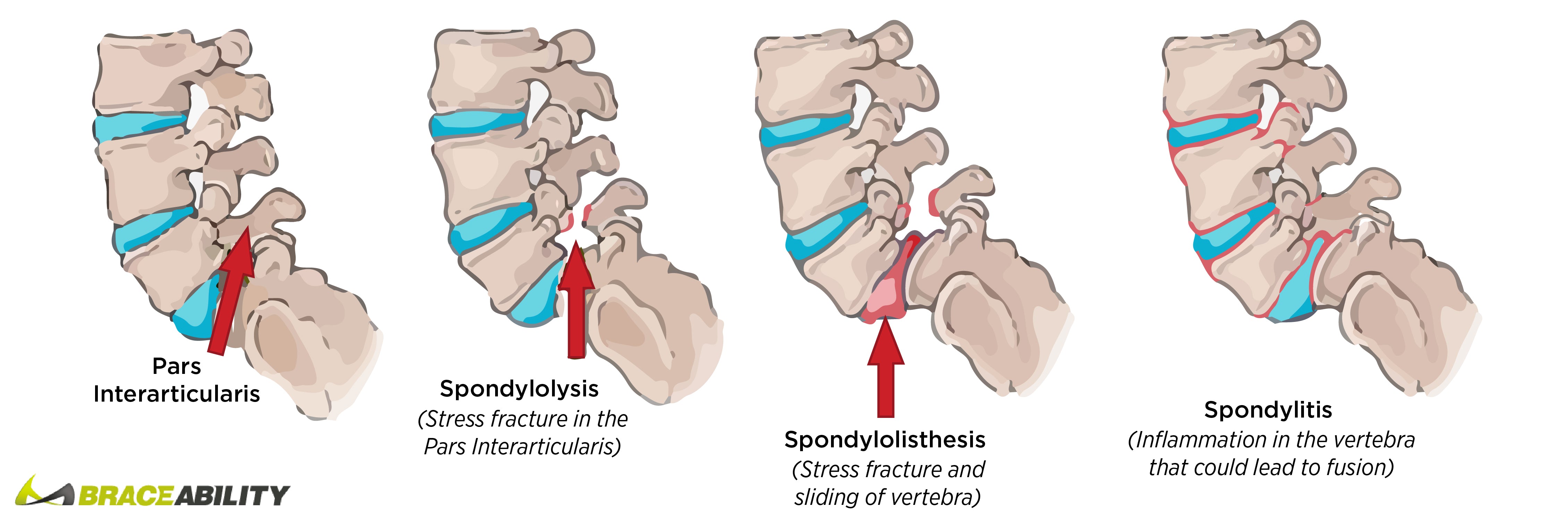 how to tell the difference between spondylolysis, spondylolisthesis and spondylitis