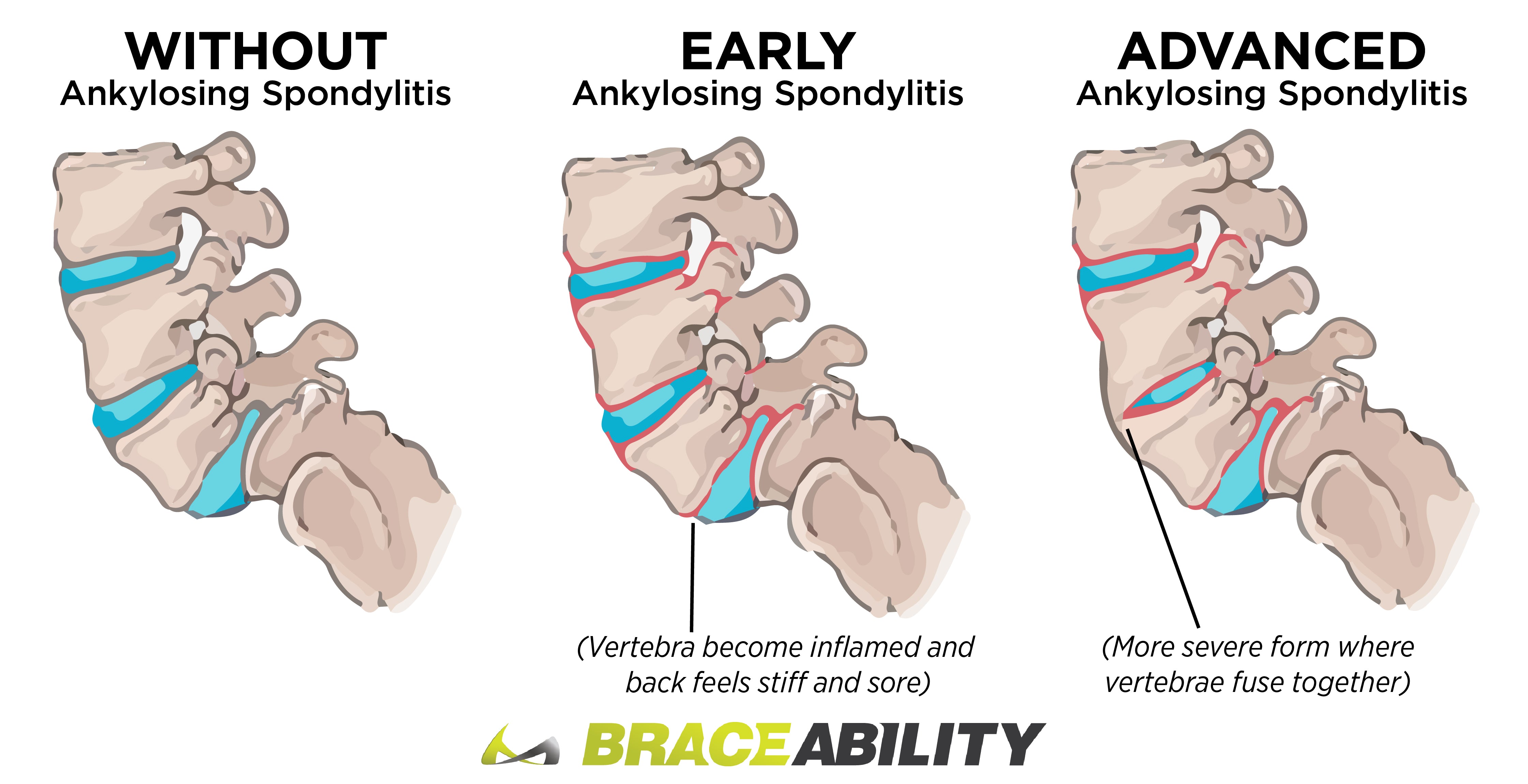 infographic showing the difference between early and advanced ankylosing spondylitis
