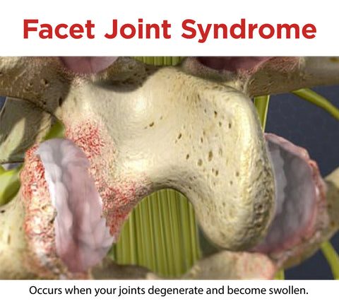 facet joint syndrome happens when joints deteriorate and grind in your back