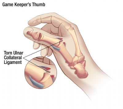 tear of the ulnar collateral ligament can be called game keeper's thumb 