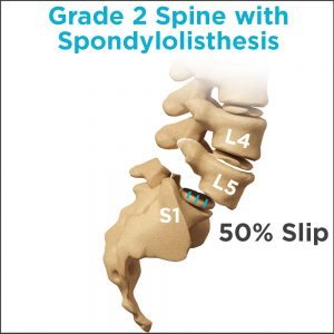 Grade 2 spondylolisthesis in lower back with 50% slippage