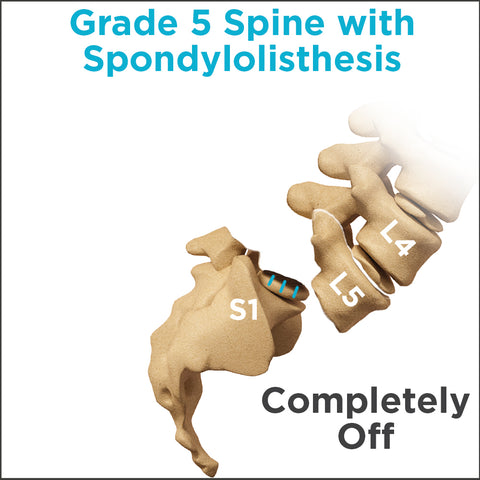 graphic displaying grade 5 spine with spondylolisthesis