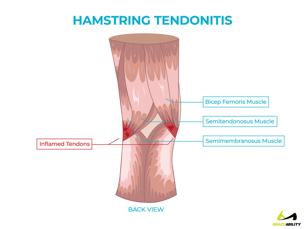 anatomy of hamstring tendonitis pain behind the knee