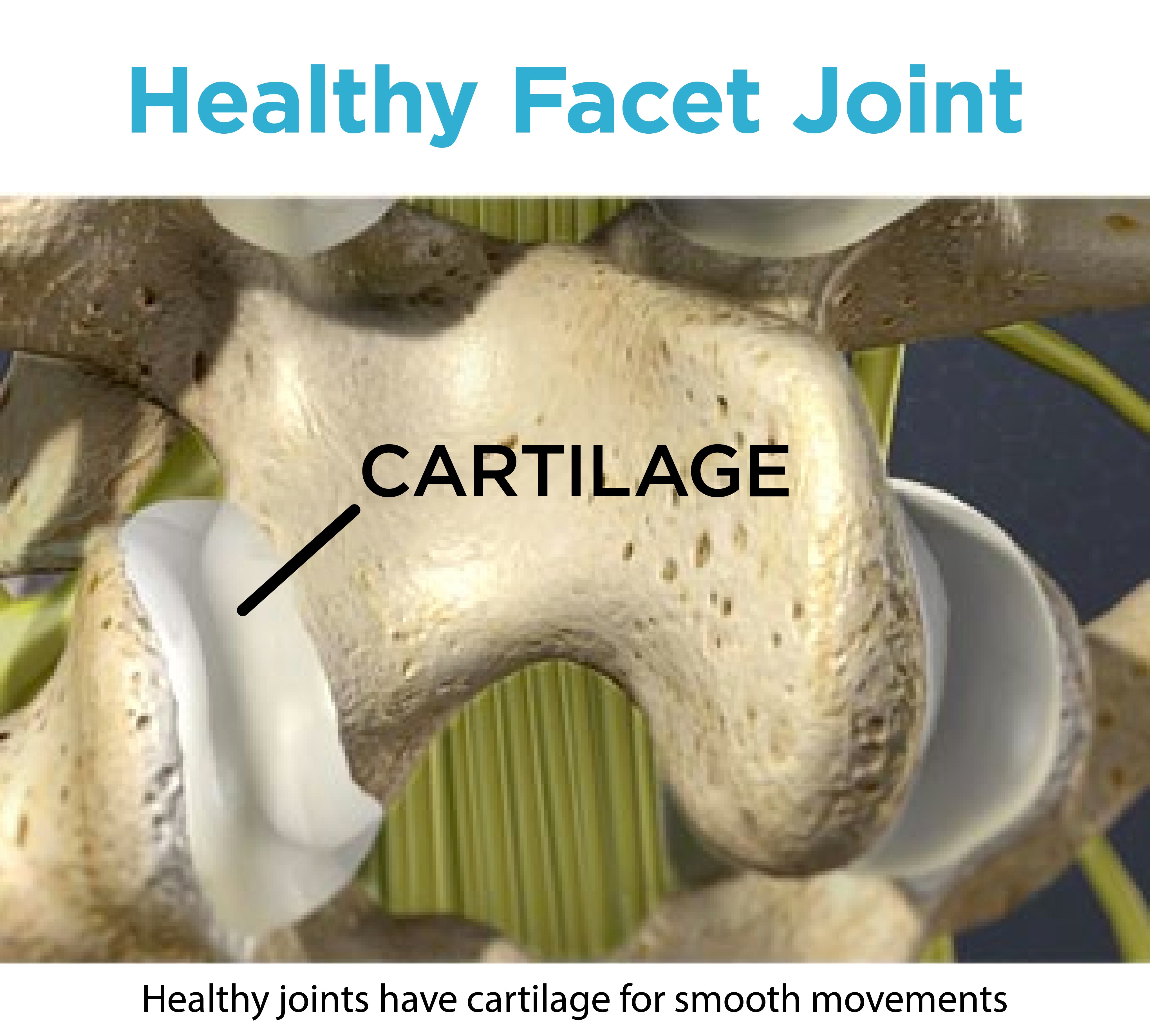 Healthy facet joints have cartilage for smooth movements