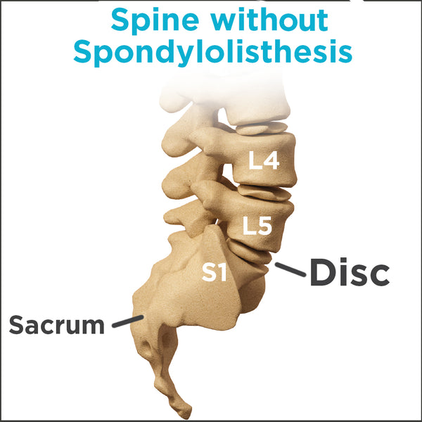 anatomy of how your lumbar looks without spondylolisthesis
