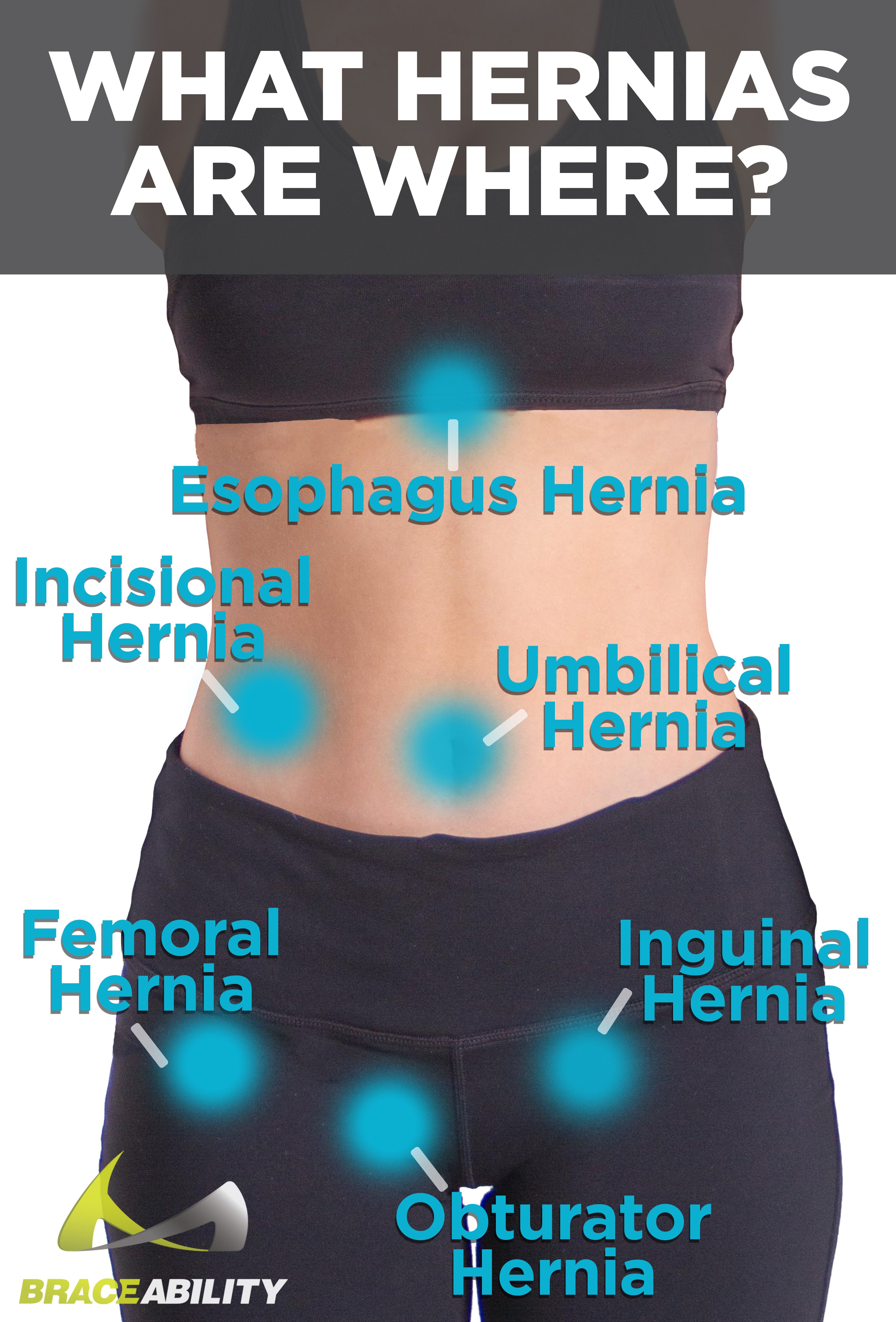 the common locations that women can get abdominal hernias