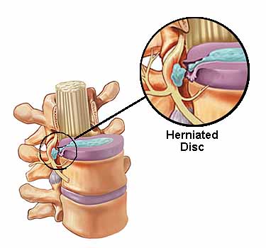 what a herniated disc looks like in the lower back