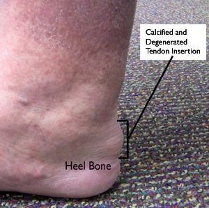 insertional achilles tendonitis affects the lower tendon attached to the heel