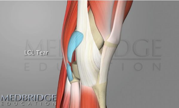 learn about lateral collateral ligament anatomy and tears