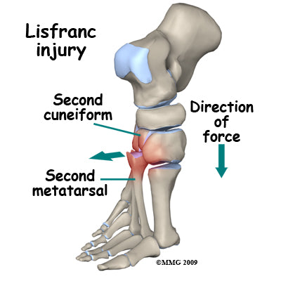 learn about lisfranc injuries including fractures, dislocations, and sprains 