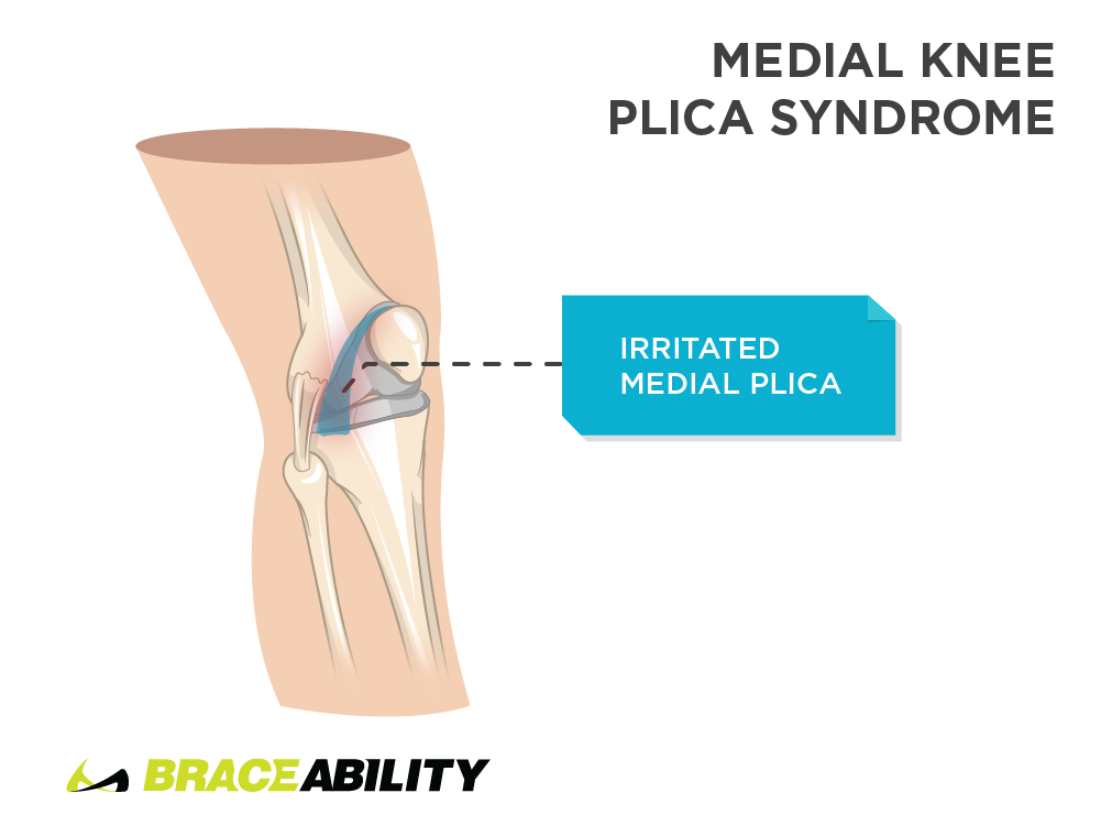 Pain inside the knee caused by medial knee plica syndrome