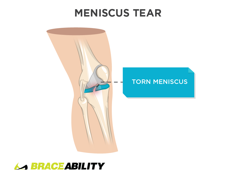 Pain inside the knee from meniscus tear