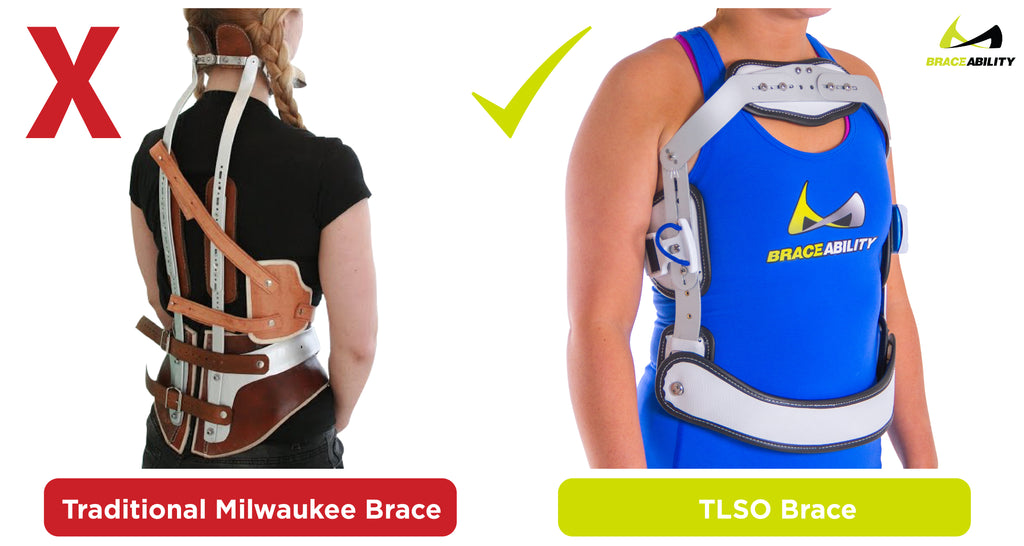 we recommend using a tlso brace rather than a milwaukee brace for scheuermann's disease
