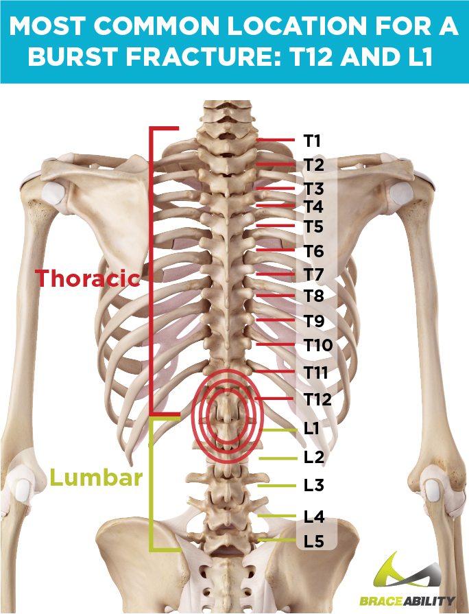 location on an anatomy chart of where t12 and l1 burst fractures happen at