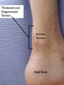 noninsertional achilles tendonitis affects the middle portion of the achilles tendon